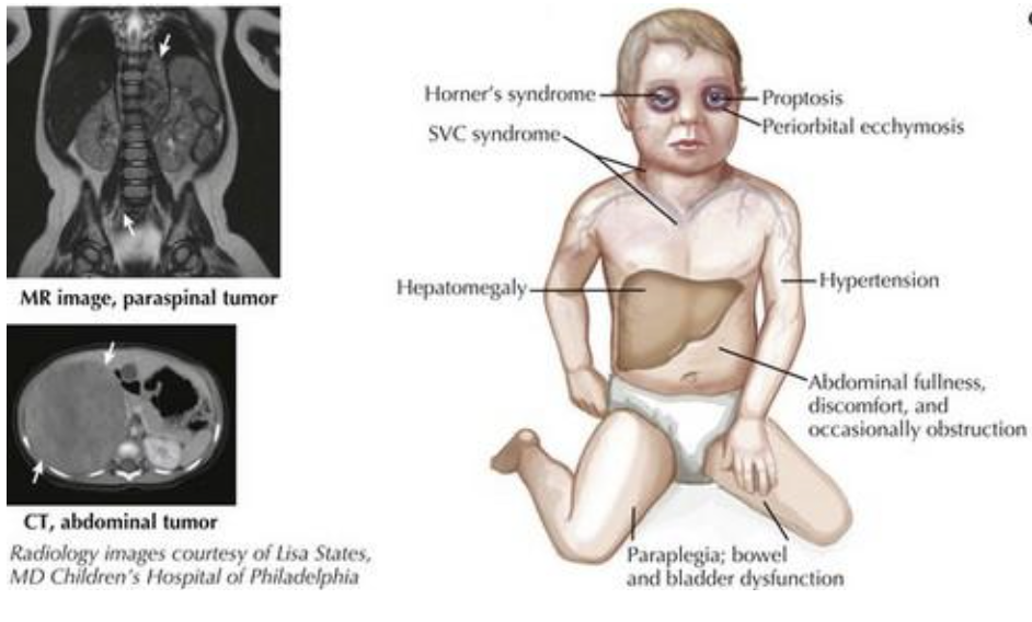 Neuroblastoma